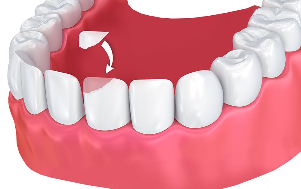 Chipped tooth and arrow to indicate bonding